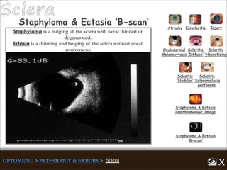 Atrophy Episcleritis Injury
Scleritis
‘Diffuse’
Scleritis
‘Necrotizing’
Scleritis
‘Nodular’
Scleritis
‘Scleromalacia
perforans’
Staphyloma & Ectasia
‘B-scan’
Staphyloma & Ectasia
‘Ophthalmologic Image’
Staphyloma & Ectasia ‘B-scan’
Oculodermal
Melanocytosis
Staphyloma is a bulging of the sclera with uveal thinned or
degenerated.
Ectasia is a thinning and bulging of the sclera without uveal
involvement.
 