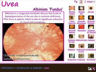 1 Next→Pg. 2
Iris Bicolor
Ciliary
Injection
Coloboma
Of Iris
Albinism
‘Fundus’
Albinism
‘Iris’
Aniridia
Choroidal
Detachment
Choroidal
Osteoma
Choroidal
Rupture
Choroiditis Coloboma
Of Choroid
Heterochromia Hyphema
Hypopyon Iridocyclitis
& iritis
Iridodialysis
Iridoschisis Iridotomy
Albinism ‘Fundus’
Albinism is a congenital metabolic disease that leads to
hypopigmenation of the eye due to melanin deficiency.
•The fovea is aplasia which results in significant reduction
in visual and nystagmus.
Choroidal vessels(arrowhead)
Retinal vessels(arrow)
 