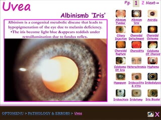 1 Next→Pg. 2
Iris Bicolor
Ciliary
Injection
Coloboma
Of Iris
Albinism
‘Fundus’
Albinism
‘Iris’
Aniridia
Choroidal
Detachment
Choroidal
Osteoma
Choroidal
Rupture
Choroiditis Coloboma
Of Choroid
Heterochromia Hyphema
Hypopyon Iridocyclitis
& iritis
Iridodialysis
Iridoschisis Iridotomy
Albinismb ‘Iris’
Albinism is a congenital metabolic disease that leads to
hypopigmenation of the eye due to melanin deficiency.
•The iris become light blue &appears reddish under
retroillumination due to fundus reflex.
 