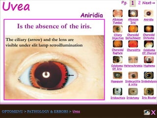 1 Next→Pg. 2
Iris Bicolor
Ciliary
Injection
Coloboma
Of Iris
Albinism
‘Fundus’
Albinism
‘Iris’
Aniridia
Choroidal
Detachment
Choroidal
Osteoma
Choroidal
Rupture
Choroiditis Coloboma
Of Choroid
Heterochromia Hyphema
Hypopyon Iridocyclitis
& iritis
Iridodialysis
Iridoschisis Iridotomy
Aniridia
Is the absence of the iris.
The ciliary (arrow) and the lens are
visible under slit lamp retroillumination
 