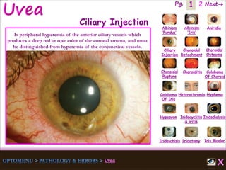 1 Next→Pg. 2
Iris Bicolor
Ciliary
Injection
Coloboma
Of Iris
Albinism
‘Fundus’
Albinism
‘Iris’
Aniridia
Choroidal
Detachment
Choroidal
Osteoma
Choroidal
Rupture
Choroiditis Coloboma
Of Choroid
Heterochromia Hyphema
Hypopyon Iridocyclitis
& iritis
Iridodialysis
Iridoschisis Iridotomy
Ciliary Injection
Is peripheral hyperemia of the anterior ciliary vessels which
produces a deep red or rose color of the corneal stroma, and must
be distinguished from hyperemia of the conjunctival vessels.
 