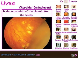 1 Next→Pg. 2
Iris Bicolor
Ciliary
Injection
Coloboma
Of Iris
Albinism
‘Fundus’
Albinism
‘Iris’
Aniridia
Choroidal
Detachment
Choroidal
Osteoma
Choroidal
Rupture
Choroiditis Coloboma
Of Choroid
Heterochromia Hyphema
Hypopyon Iridocyclitis
& iritis
Iridodialysis
Iridoschisis Iridotomy
Choroidal Detachment
Is the separation of the choroid from
the sclera.
 