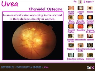 1 Next→Pg. 2
Iris Bicolor
Ciliary
Injection
Coloboma
Of Iris
Albinism
‘Fundus’
Albinism
‘Iris’
Aniridia
Choroidal
Detachment
Choroidal
Osteoma
Choroidal
Rupture
Choroiditis Coloboma
Of Choroid
Heterochromia Hyphema
Hypopyon Iridocyclitis
& iritis
Iridodialysis
Iridoschisis Iridotomy
Choroidal Osteoma
Is an ossified lesion occurring in the second
to third decade, mainly in women.
 