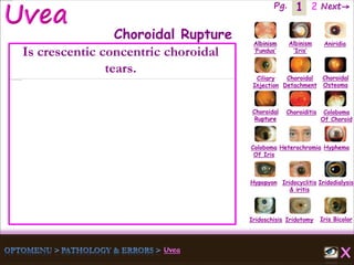 1 Next→Pg. 2
Iris Bicolor
Ciliary
Injection
Coloboma
Of Iris
Albinism
‘Fundus’
Albinism
‘Iris’
Aniridia
Choroidal
Detachment
Choroidal
Osteoma
Choroidal
Rupture
Choroiditis Coloboma
Of Choroid
Heterochromia Hyphema
Hypopyon Iridocyclitis
& iritis
Iridodialysis
Iridoschisis Iridotomy
Choroidal Rupture
Is crescentic concentric choroidal
tears.
 