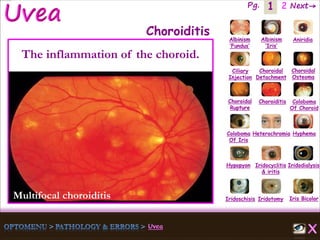 1 Next→Pg. 2
Multifocal choroiditis Iris Bicolor
Ciliary
Injection
Coloboma
Of Iris
Albinism
‘Fundus’
Albinism
‘Iris’
Aniridia
Choroidal
Detachment
Choroidal
Osteoma
Choroidal
Rupture
Choroiditis Coloboma
Of Choroid
Heterochromia Hyphema
Hypopyon Iridocyclitis
& iritis
Iridodialysis
Iridoschisis Iridotomy
Choroiditis
The inflammation of the choroid.
 