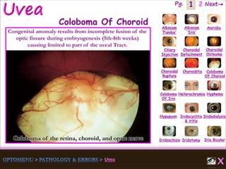 1 Next→Pg. 2
Coloboma of the retina, choroid, and optic nerve Iris Bicolor
Ciliary
Injection
Coloboma
Of Iris
Albinism
‘Fundus’
Albinism
‘Iris’
Aniridia
Choroidal
Detachment
Choroidal
Osteoma
Choroidal
Rupture
Choroiditis Coloboma
Of Choroid
Heterochromia Hyphema
Hypopyon Iridocyclitis
& iritis
Iridodialysis
Iridoschisis Iridotomy
Coloboma Of Choroid
Congenital anomaly results from incomplete fusion of the
optic fissure during embryogenesis (5th-8th weeks)
causing limited to part of the uveal Tract.
 