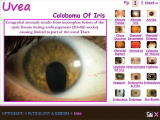1 Next→Pg. 2
Iris Bicolor
Ciliary
Injection
Coloboma
Of Iris
Albinism
‘Fundus’
Albinism
‘Iris’
Aniridia
Choroidal
Detachment
Choroidal
Osteoma
Choroidal
Rupture
Choroiditis Coloboma
Of Choroid
Heterochromia Hyphema
Hypopyon Iridocyclitis
& iritis
Iridodialysis
Iridoschisis Iridotomy
Coloboma Of Iris
Congenital anomaly results from incomplete fusion of the
optic fissure during embryogenesis (5th-8th weeks)
causing limited to part of the uveal Tract.
 