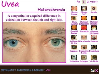 1 Next→Pg. 2
Iris Bicolor
Ciliary
Injection
Coloboma
Of Iris
Albinism
‘Fundus’
Albinism
‘Iris’
Aniridia
Choroidal
Detachment
Choroidal
Osteoma
Choroidal
Rupture
Choroiditis Coloboma
Of Choroid
Heterochromia Hyphema
Hypopyon Iridocyclitis
& iritis
Iridodialysis
Iridoschisis Iridotomy
Heterochromia
A congenital or acquired difference in
coloration between the left and right iris.
 
