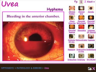 1 Next→Pg. 2
Iris Bicolor
Ciliary
Injection
Coloboma
Of Iris
Albinism
‘Fundus’
Albinism
‘Iris’
Aniridia
Choroidal
Detachment
Choroidal
Osteoma
Choroidal
Rupture
Choroiditis Coloboma
Of Choroid
Heterochromia Hyphema
Hypopyon Iridocyclitis
& iritis
Iridodialysis
Iridoschisis Iridotomy
Hyphema
Bleeding in the anterior chamber.
 
