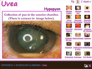 1 Next→Pg. 2
Iris Bicolor
Ciliary
Injection
Coloboma
Of Iris
Albinism
‘Fundus’
Albinism
‘Iris’
Aniridia
Choroidal
Detachment
Choroidal
Osteoma
Choroidal
Rupture
Choroiditis Coloboma
Of Choroid
Heterochromia Hyphema
Hypopyon Iridocyclitis
& iritis
Iridodialysis
Iridoschisis Iridotomy
Hypopyon
Collection of pus in the anterior chamber.
(There is cataract in image below).
 