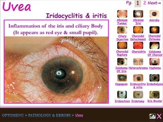 1 Next→Pg. 2
Iris Bicolor
Ciliary
Injection
Coloboma
Of Iris
Albinism
‘Fundus’
Albinism
‘Iris’
Aniridia
Choroidal
Detachment
Choroidal
Osteoma
Choroidal
Rupture
Choroiditis Coloboma
Of Choroid
Heterochromia Hyphema
Hypopyon Iridocyclitis
& iritis
Iridodialysis
Iridoschisis Iridotomy
Iridocyclitis & iritis
Inflammation of the iris and ciliary Body
(It appears as red eye & small pupil).
 