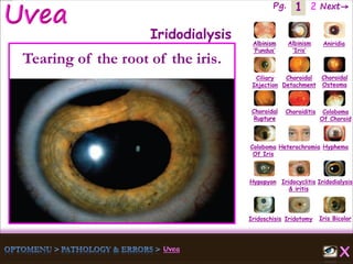1 Next→Pg. 2
Iris Bicolor
Ciliary
Injection
Coloboma
Of Iris
Albinism
‘Fundus’
Albinism
‘Iris’
Aniridia
Choroidal
Detachment
Choroidal
Osteoma
Choroidal
Rupture
Choroiditis Coloboma
Of Choroid
Heterochromia Hyphema
Hypopyon Iridocyclitis
& iritis
Iridodialysis
Iridoschisis Iridotomy
Iridodialysis
Tearing of the root of the iris.
 