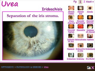 1 Next→Pg. 2
Iris Bicolor
Ciliary
Injection
Coloboma
Of Iris
Albinism
‘Fundus’
Albinism
‘Iris’
Aniridia
Choroidal
Detachment
Choroidal
Osteoma
Choroidal
Rupture
Choroiditis Coloboma
Of Choroid
Heterochromia Hyphema
Hypopyon Iridocyclitis
& iritis
Iridodialysis
Iridoschisis Iridotomy
Iridoschisis
Separation of the iris stroma.
 