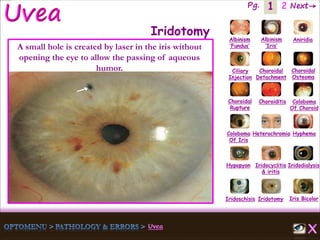 1 Next→Pg. 2
Iris Bicolor
Ciliary
Injection
Coloboma
Of Iris
Albinism
‘Fundus’
Albinism
‘Iris’
Aniridia
Choroidal
Detachment
Choroidal
Osteoma
Choroidal
Rupture
Choroiditis Coloboma
Of Choroid
Heterochromia Hyphema
Hypopyon Iridocyclitis
& iritis
Iridodialysis
Iridoschisis Iridotomy
Iridotomy
A small hole is created by laser in the iris without
opening the eye to allow the passing of aqueous
humor.
 