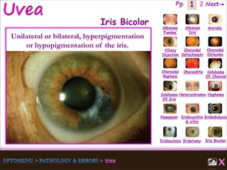 1 Next→Pg. 2
Iris Bicolor
Ciliary
Injection
Coloboma
Of Iris
Albinism
‘Fundus’
Albinism
‘Iris’
Aniridia
Choroidal
Detachment
Choroidal
Osteoma
Choroidal
Rupture
Choroiditis Coloboma
Of Choroid
Heterochromia Hyphema
Hypopyon Iridocyclitis
& iritis
Iridodialysis
Iridoschisis Iridotomy
Iris Bicolor
Unilateral or bilateral, hyperpigmentation
or hypopigmentation of the iris.
 