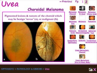 2←Previous Pg. 1
Melanoma
‘Choroid’
Melanoma
‘B-Scan’
Melanoma
‘Ciliary body’
Melanoma
‘Iris’
Melanosis Panuveitis
Rubeosis
Iridis
Serpiginous
Chorioretinopathy
Sphincter
Tear
Sympathetic
Ophthalmia
Synechia Toxoplasmosis
Retinochoroiditis
Uveal Metastasis
‘Choroid’
Uveal Metastasis
'Iris & Ciliary Body'
Choroidal Melanoma
Pigmented lesions & tumors of the choroid which
may be benign 'nevus' (a), or malignant (b).
a b
 