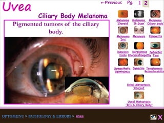2←Previous Pg. 1
Melanoma
‘Choroid’
Melanoma
‘B-Scan’
Melanoma
‘Ciliary body’
Melanoma
‘Iris’
Melanosis Panuveitis
Rubeosis
Iridis
Serpiginous
Chorioretinopathy
Sphincter
Tear
Sympathetic
Ophthalmia
Synechia Toxoplasmosis
Retinochoroiditis
Uveal Metastasis
‘Choroid’
Uveal Metastasis
'Iris & Ciliary Body'
Ciliary Body Melanoma
Pigmented tumors of the ciliary
body.
 