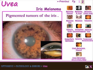 2←Previous Pg. 1
Melanoma
‘Choroid’
Melanoma
‘B-Scan’
Melanoma
‘Ciliary body’
Melanoma
‘Iris’
Melanosis Panuveitis
Rubeosis
Iridis
Serpiginous
Chorioretinopathy
Sphincter
Tear
Sympathetic
Ophthalmia
Synechia Toxoplasmosis
Retinochoroiditis
Uveal Metastasis
‘Choroid’
Uveal Metastasis
'Iris & Ciliary Body'
Iris Melanoma
Pigmented tumors of the iris .
 