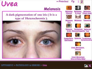 2←Previous Pg. 1
Melanoma
‘Choroid’
Melanoma
‘B-Scan’
Melanoma
‘Ciliary body’
Melanoma
‘Iris’
Melanosis Panuveitis
Rubeosis
Iridis
Serpiginous
Chorioretinopathy
Sphincter
Tear
Sympathetic
Ophthalmia
Synechia Toxoplasmosis
Retinochoroiditis
Uveal Metastasis
‘Choroid’
Uveal Metastasis
'Iris & Ciliary Body'
Melanosis
A dark pigmentation of one iris ( It is a
type of Heterochromia ).
 
