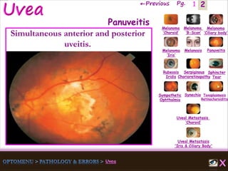 2←Previous Pg. 1
Melanoma
‘Choroid’
Melanoma
‘B-Scan’
Melanoma
‘Ciliary body’
Melanoma
‘Iris’
Melanosis Panuveitis
Rubeosis
Iridis
Serpiginous
Chorioretinopathy
Sphincter
Tear
Sympathetic
Ophthalmia
Synechia Toxoplasmosis
Retinochoroiditis
Uveal Metastasis
‘Choroid’
Uveal Metastasis
'Iris & Ciliary Body'
Panuveitis
Simultaneous anterior and posterior
uveitis.
 