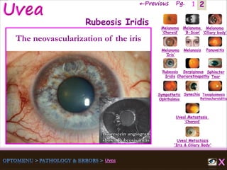 2←Previous Pg. 1
fluorescein angiogram
shown Rubeosis iridis
Melanoma
‘Choroid’
Melanoma
‘B-Scan’
Melanoma
‘Ciliary body’
Melanoma
‘Iris’
Melanosis Panuveitis
Rubeosis
Iridis
Serpiginous
Chorioretinopathy
Sphincter
Tear
Sympathetic
Ophthalmia
Synechia Toxoplasmosis
Retinochoroiditis
Uveal Metastasis
‘Choroid’
Uveal Metastasis
'Iris & Ciliary Body'
Rubeosis Iridis
The neovascularization of the iris
 