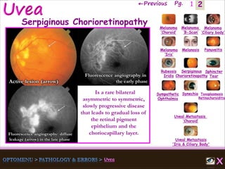 2←Previous Pg. 1
Fluorescence angiography in
the early phaseActive lesion (arrow)
Fluorescence angiography: diffuse
leakage (arrow) in the late phase
Melanoma
‘Choroid’
Melanoma
‘B-Scan’
Melanoma
‘Ciliary body’
Melanoma
‘Iris’
Melanosis Panuveitis
Rubeosis
Iridis
Serpiginous
Chorioretinopathy
Sphincter
Tear
Sympathetic
Ophthalmia
Synechia Toxoplasmosis
Retinochoroiditis
Uveal Metastasis
‘Choroid’
Uveal Metastasis
'Iris & Ciliary Body'
Serpiginous Chorioretinopathy
Is a rare bilateral
asymmetric to symmetric,
slowly progressive disease
that leads to gradual loss of
the retinal pigment
epithelium and the
choriocapillary layer.
 