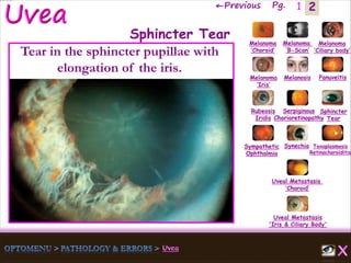 2←Previous Pg. 1
Melanoma
‘Choroid’
Melanoma
‘B-Scan’
Melanoma
‘Ciliary body’
Melanoma
‘Iris’
Melanosis Panuveitis
Rubeosis
Iridis
Serpiginous
Chorioretinopathy
Sphincter
Tear
Sympathetic
Ophthalmia
Synechia Toxoplasmosis
Retinochoroiditis
Uveal Metastasis
‘Choroid’
Uveal Metastasis
'Iris & Ciliary Body'
Sphincter Tear
Tear in the sphincter pupillae with
elongation of the iris.
 