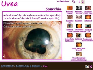 2←Previous Pg. 1
Melanoma
‘Choroid’
Melanoma
‘B-Scan’
Melanoma
‘Ciliary body’
Melanoma
‘Iris’
Melanosis Panuveitis
Rubeosis
Iridis
Serpiginous
Chorioretinopathy
Sphincter
Tear
Sympathetic
Ophthalmia
Synechia Toxoplasmosis
Retinochoroiditis
Uveal Metastasis
‘Choroid’
Uveal Metastasis
'Iris & Ciliary Body'
Synechia
Adhesions of the iris and cornea (Anterior synechia)
or adhesions of the iris & lens (Posterior synechia).
Cloverleaf pupil appears in image
due to posterior synechia
 