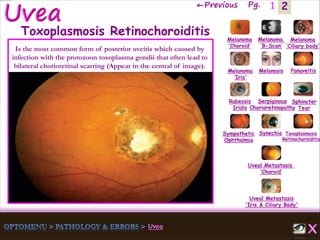 2←Previous Pg. 1
Melanoma
‘Choroid’
Melanoma
‘B-Scan’
Melanoma
‘Ciliary body’
Melanoma
‘Iris’
Melanosis Panuveitis
Rubeosis
Iridis
Serpiginous
Chorioretinopathy
Sphincter
Tear
Sympathetic
Ophthalmia
Synechia Toxoplasmosis
Retinochoroiditis
Uveal Metastasis
‘Choroid’
Uveal Metastasis
'Iris & Ciliary Body'
Toxoplasmosis Retinochoroiditis
Is the most common form of posterior uveitis which caused by
infection with the protozoon toxoplasma gondii that often lead to
bilateral chorioretinal scarring (Appear in the central of image).
 