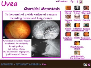 2←Previous Pg. 1
Choroidal metastatic breast
carcinoma in an elderly
female patient.
(a) Colour photo.
(b) Fluorescein angiogram.
(c) Ultrasound B-scan
a b
c
Melanoma
‘Choroid’
Melanoma
‘B-Scan’
Melanoma
‘Ciliary body’
Melanoma
‘Iris’
Melanosis Panuveitis
Rubeosis
Iridis
Serpiginous
Chorioretinopathy
Sphincter
Tear
Sympathetic
Ophthalmia
Synechia Toxoplasmosis
Retinochoroiditis
Uveal Metastasis
‘Choroid’
Uveal Metastasis
'Iris & Ciliary Body'
Choroidal Metastasis
Is the result of a wide variety of cancers
including breast and lung cancer.
 