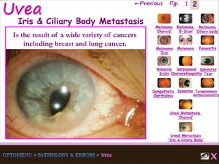 2←Previous Pg. 1
Melanoma
‘Choroid’
Melanoma
‘B-Scan’
Melanoma
‘Ciliary body’
Melanoma
‘Iris’
Melanosis Panuveitis
Rubeosis
Iridis
Serpiginous
Chorioretinopathy
Sphincter
Tear
Sympathetic
Ophthalmia
Synechia Toxoplasmosis
Retinochoroiditis
Uveal Metastasis
‘Choroid’
Uveal Metastasis
'Iris & Ciliary Body'
Iris & Ciliary Body Metastasis
Is the result of a wide variety of cancers
including breast and lung cancer.
 