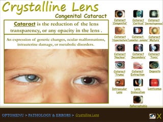 Crystalline Lens
Cataract
‘Congenital’
Cataract
‘Cortical’
Cataract
‘Dermatogenous’
Cataract
‘Hypermature’
Cataract
‘Lamellar-zonular’
Cataract
‘Mature’
Cataract
‘Nuclear’
Cataract
‘Secondary’
Cataract
‘Toxic’
Cataract
‘Truma’
Cataract
Extraction
Deposits
Intraocular
Lens
Lens
Dislocation
Lenticonus
Spherophakia
Congenital Cataract
An expression of genetic changes, ocular malformations,
intrauterine damage, or metabolic disorders.
Cataract is the reduction of the lens
transparency, or any opacity in the lens .
 