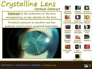Crystalline Lens
Cataract
‘Congenital’
Cataract
‘Cortical’
Cataract
‘Dermatogenous’
Cataract
‘Hypermature’
Cataract
‘Lamellar-zonular’
Cataract
‘Mature’
Cataract
‘Nuclear’
Cataract
‘Secondary’
Cataract
‘Toxic’
Cataract
‘Truma’
Cataract
Extraction
Deposits
Intraocular
Lens
Lens
Dislocation
Lenticonus
Spherophakia
Cortical Cataract
Cortical cataracts as nuclear one but
patients tend to have acquired hyperopia.
Cataract is the reduction of the lens
transparency, or any opacity in the lens .
 