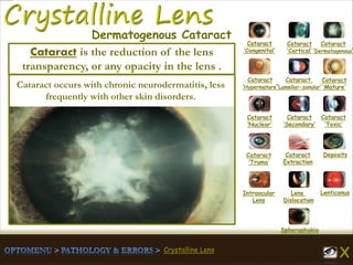 Crystalline Lens
Cataract
‘Congenital’
Cataract
‘Cortical’
Cataract
‘Dermatogenous’
Cataract
‘Hypermature’
Cataract
‘Lamellar-zonular’
Cataract
‘Mature’
Cataract
‘Nuclear’
Cataract
‘Secondary’
Cataract
‘Toxic’
Cataract
‘Truma’
Cataract
Extraction
Deposits
Intraocular
Lens
Lens
Dislocation
Lenticonus
Spherophakia
Dermatogenous Cataract
Cataract occurs with chronic neurodermatitis, less
frequently with other skin disorders.
Cataract is the reduction of the lens
transparency, or any opacity in the lens .
 