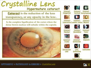 Crystalline Lens
Cataract
‘Congenital’
Cataract
‘Cortical’
Cataract
‘Dermatogenous’
Cataract
‘Hypermature’
Cataract
‘Lamellar-zonular’
Cataract
‘Mature’
Cataract
‘Nuclear’
Cataract
‘Secondary’
Cataract
‘Toxic’
Cataract
‘Truma’
Cataract
Extraction
Deposits
Intraocular
Lens
Lens
Dislocation
Lenticonus
Spherophakia
Hypermature cataract
Is the complete liquification of the cortex where the
dense brown nucleus will subside within the capsule.
Cataract is the reduction of the lens
transparency, or any opacity in the lens .
 