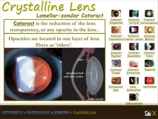 Crystalline Lens
Cataract
‘Congenital’
Cataract
‘Cortical’
Cataract
‘Dermatogenous’
Cataract
‘Hypermature’
Cataract
‘Lamellar-zonular’
Cataract
‘Mature’
Cataract
‘Nuclear’
Cataract
‘Secondary’
Cataract
‘Toxic’
Cataract
‘Truma’
Cataract
Extraction
Deposits
Intraocular
Lens
Lens
Dislocation
Lenticonus
Spherophakia
Lamellar-zonular Cataract
Opacities are located in one layer of lens
fibers as 'riders'.
Cataract is the reduction of the lens
transparency, or any opacity in the lens .
 