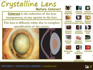 Crystalline Lens
Cataract
‘Congenital’
Cataract
‘Cortical’
Cataract
‘Dermatogenous’
Cataract
‘Hypermature’
Cataract
‘Lamellar-zonular’
Cataract
‘Mature’
Cataract
‘Nuclear’
Cataract
‘Secondary’
Cataract
‘Toxic’
Cataract
‘Truma’
Cataract
Extraction
Deposits
Intraocular
Lens
Lens
Dislocation
Lenticonus
Spherophakia
Mature Cataract
The lens is diffusely white due to complete
opacification of the cortex.
Cataract is the reduction of the lens
transparency, or any opacity in the lens .
 
