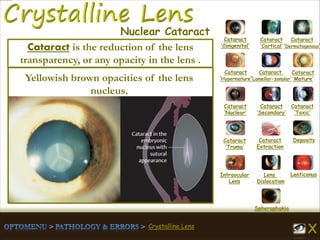 Crystalline Lens
Cataract
‘Congenital’
Cataract
‘Cortical’
Cataract
‘Dermatogenous’
Cataract
‘Hypermature’
Cataract
‘Lamellar-zonular’
Cataract
‘Mature’
Cataract
‘Nuclear’
Cataract
‘Secondary’
Cataract
‘Toxic’
Cataract
‘Truma’
Cataract
Extraction
Deposits
Intraocular
Lens
Lens
Dislocation
Lenticonus
Spherophakia
Nuclear Cataract
Yellowish brown opacities of the lens
nucleus.
Cataract is the reduction of the lens
transparency, or any opacity in the lens .
 