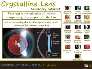 Crystalline Lens
Cataract
‘Congenital’
Cataract
‘Cortical’
Cataract
‘Dermatogenous’
Cataract
‘Hypermature’
Cataract
‘Lamellar-zonular’
Cataract
‘Mature’
Cataract
‘Nuclear’
Cataract
‘Secondary’
Cataract
‘Toxic’
Cataract
‘Truma’
Cataract
Extraction
Deposits
Intraocular
Lens
Lens
Dislocation
Lenticonus
Spherophakia
Secondary cataract
Cataract occurring due to other eye diseases or after
extracapsular cataract extraction.
Cataract is the reduction of the lens
transparency, or any opacity in the lens .
 