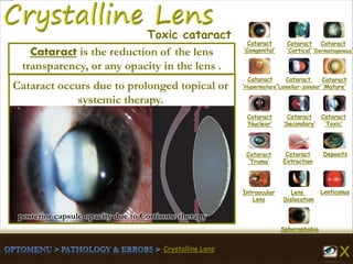 Crystalline Lens
Cataract
‘Congenital’
Cataract
‘Cortical’
Cataract
‘Dermatogenous’
Cataract
‘Hypermature’
Cataract
‘Lamellar-zonular’
Cataract
‘Mature’
Cataract
‘Nuclear’
Cataract
‘Secondary’
Cataract
‘Toxic’
Cataract
‘Truma’
Cataract
Extraction
Deposits
Intraocular
Lens
Lens
Dislocation
Lenticonus
Spherophakia
Toxic cataract
Cataract occurs due to prolonged topical or
systemic therapy.
Cataract is the reduction of the lens
transparency, or any opacity in the lens .
posterior capsule opacity due to Cortisone therapy
 