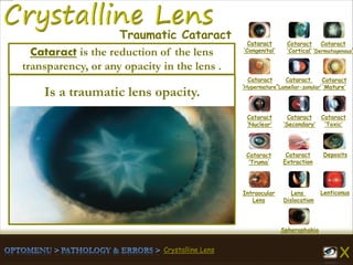 Crystalline Lens
Cataract
‘Congenital’
Cataract
‘Cortical’
Cataract
‘Dermatogenous’
Cataract
‘Hypermature’
Cataract
‘Lamellar-zonular’
Cataract
‘Mature’
Cataract
‘Nuclear’
Cataract
‘Secondary’
Cataract
‘Toxic’
Cataract
‘Truma’
Cataract
Extraction
Deposits
Intraocular
Lens
Lens
Dislocation
Lenticonus
Spherophakia
Traumatic Cataract
Is a traumatic lens opacity.
Cataract is the reduction of the lens
transparency, or any opacity in the lens .
 