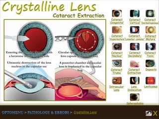 Crystalline Lens
Entering the anterior chamber with
a keratome from temporal side
Circular opening of the anterior
lens capsule (capsulorhexis)
A posterior chamber intraocular
lens is implanted in the capsular
bag.
Ultrasonic destruction of the lens
nucleus in the capsular sac
Cataract
‘Congenital’
Cataract
‘Cortical’
Cataract
‘Dermatogenous’
Cataract
‘Hypermature’
Cataract
‘Lamellar-zonular’
Cataract
‘Mature’
Cataract
‘Nuclear’
Cataract
‘Secondary’
Cataract
‘Toxic’
Cataract
‘Truma’
Cataract
Extraction
Deposits
Intraocular
Lens
Lens
Dislocation
Lenticonus
Spherophakia
Cataract Extraction
 