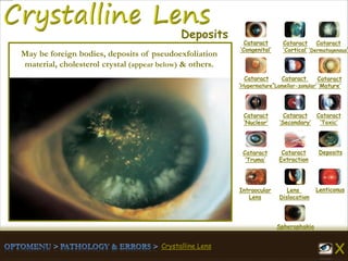 Crystalline Lens
Cataract
‘Congenital’
Cataract
‘Cortical’
Cataract
‘Dermatogenous’
Cataract
‘Hypermature’
Cataract
‘Lamellar-zonular’
Cataract
‘Mature’
Cataract
‘Nuclear’
Cataract
‘Secondary’
Cataract
‘Toxic’
Cataract
‘Truma’
Cataract
Extraction
Deposits
Intraocular
Lens
Lens
Dislocation
Lenticonus
Spherophakia
Deposits
May be foreign bodies, deposits of pseudoexfoliation
material, cholesterol crystal (appear below) & others.
 