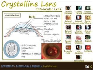 Crystalline Lens
IOL implant within capsular bag
appear after dilation of pupil
Cataract
‘Congenital’
Cataract
‘Cortical’
Cataract
‘Dermatogenous’
Cataract
‘Hypermature’
Cataract
‘Lamellar-zonular’
Cataract
‘Mature’
Cataract
‘Nuclear’
Cataract
‘Secondary’
Cataract
‘Toxic’
Cataract
‘Truma’
Cataract
Extraction
Deposits
Intraocular
Lens
Lens
Dislocation
Lenticonus
Spherophakia
Intraocular Lens
R343
 