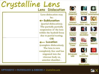 Crystalline Lens
Lens dislocation may
be:
Subluxation
(partial dislocation);
The partially partially
suspension of the lens
within the hyaloid fossa
due to partial tearing.
OR
Luxation
(complete dislocation);
The lens is torn
completely free and has
migrated into the
vitreous body or,
anterior chamber .
Cataract
‘Congenital’
Cataract
‘Cortical’
Cataract
‘Dermatogenous’
Cataract
‘Hypermature’
Cataract
‘Lamellar-zonular’
Cataract
‘Mature’
Cataract
‘Nuclear’
Cataract
‘Secondary’
Cataract
‘Toxic’
Cataract
‘Truma’
Cataract
Extraction
Deposits
Intraocular
Lens
Lens
Dislocation
Lenticonus
Spherophakia
Lens Dislocation
 