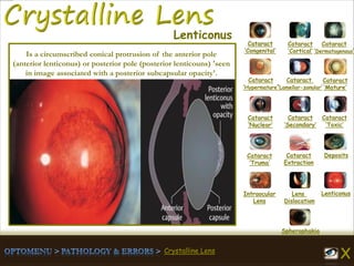 Crystalline Lens
Cataract
‘Congenital’
Cataract
‘Cortical’
Cataract
‘Dermatogenous’
Cataract
‘Hypermature’
Cataract
‘Lamellar-zonular’
Cataract
‘Mature’
Cataract
‘Nuclear’
Cataract
‘Secondary’
Cataract
‘Toxic’
Cataract
‘Truma’
Cataract
Extraction
Deposits
Intraocular
Lens
Lens
Dislocation
Lenticonus
Spherophakia
Lenticonus
Is a circumscribed conical protrusion of the anterior pole
(anterior lenticonus) or posterior pole (posterior lenticouns) 'seen
in image associated with a posterior subcapsular opacity'.
 