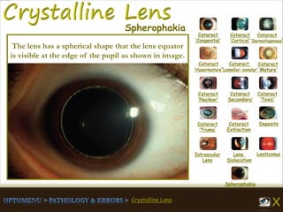 Crystalline Lens
Cataract
‘Congenital’
Cataract
‘Cortical’
Cataract
‘Dermatogenous’
Cataract
‘Hypermature’
Cataract
‘Lamellar-zonular’
Cataract
‘Mature’
Cataract
‘Nuclear’
Cataract
‘Secondary’
Cataract
‘Toxic’
Cataract
‘Truma’
Cataract
Extraction
Deposits
Intraocular
Lens
Lens
Dislocation
Lenticonus
Spherophakia
Spherophakia
The lens has a spherical shape that the lens equator
is visible at the edge of the pupil as shown in image.
 