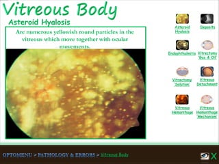 Vitreous Body
Vitreous
Hemorrhage
‘Mechanism’
Vitreous
Hemorrhage
Vitreous
Detachment
Vitrectomy
‘Solution’
Vitrectomy
‘Gas & Oil’
Endophthalmitis
Asteroid
Hyalosis
Deposits
Are numerous yellowish round particles in the
vitreous which move together with ocular
movements.
Asteroid Hyalosis
 