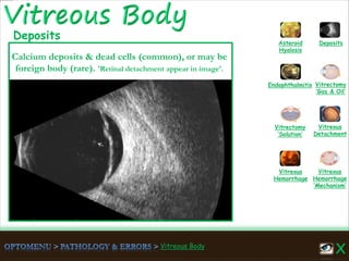 Vitreous Body
Vitreous
Hemorrhage
‘Mechanism’
Vitreous
Hemorrhage
Vitreous
Detachment
Vitrectomy
‘Solution’
Vitrectomy
‘Gas & Oil’
Endophthalmitis
Asteroid
Hyalosis
Deposits
Calcium deposits & dead cells (common), or may be
foreign body (rare). 'Retinal detachment appear in image'.
Deposits
 