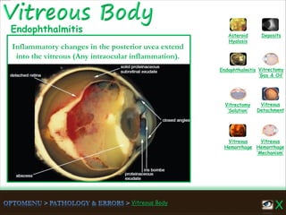 Vitreous Body
Vitreous
Hemorrhage
‘Mechanism’
Vitreous
Hemorrhage
Vitreous
Detachment
Vitrectomy
‘Solution’
Vitrectomy
‘Gas & Oil’
Endophthalmitis
Asteroid
Hyalosis
Deposits
Endophthalmitis
Inflammatory changes in the posterior uvea extend
into the vitreous (Any intraocular inflammation).
 